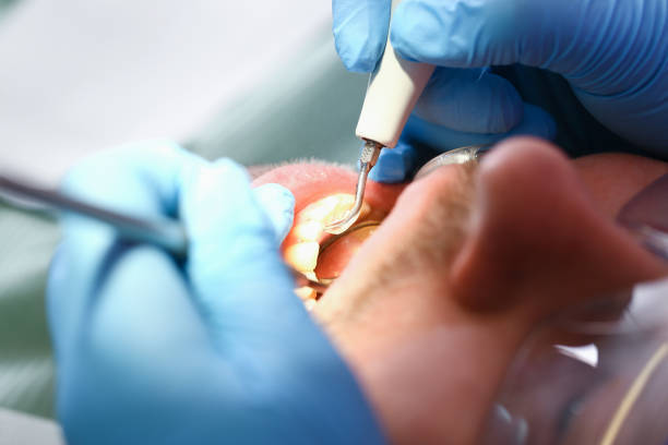 Best Emergency Wisdom Teeth Removal in Bryson City, NC